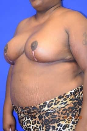 Breast Reduction
