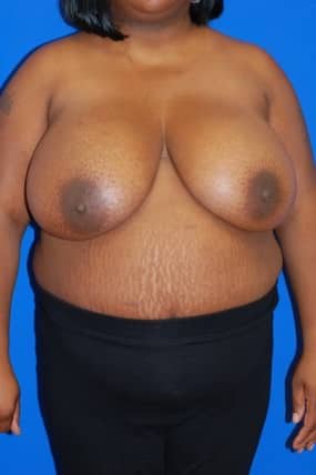 Breast Reduction