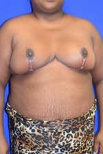 Breast Reduction