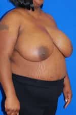 Breast Reduction