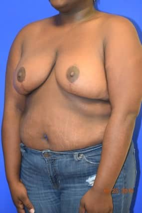 Breast Reduction
