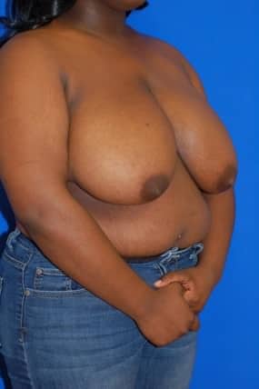 Breast Reduction