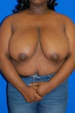 Breast Reduction