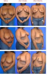 Breast Reduction