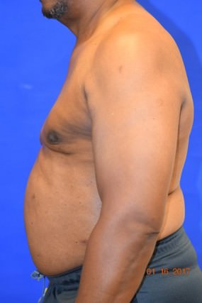 Male Breast Reduction