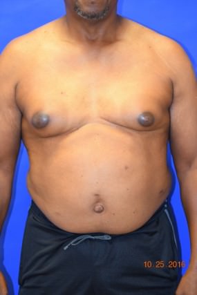 Male Breast Reduction