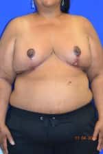 Breast Reduction