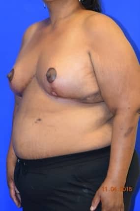 Breast Reduction