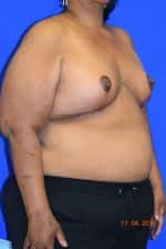 Breast Reduction