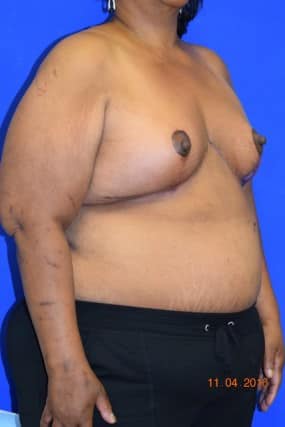 Breast Reduction