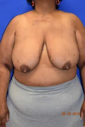 Breast Reduction