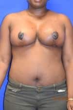 Breast Reduction