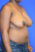 Breast Reduction