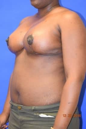 Breast Reduction