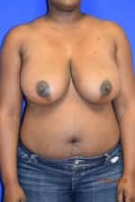 Breast Reduction