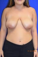Breast Reduction