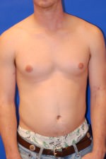 Breast Reduction Before and After Photos by Randy Proffitt, MD