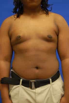 Male Breast Reduction
