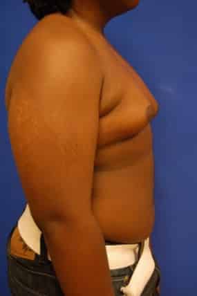Male Breast Reduction