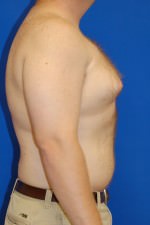 Male Breast Reduction