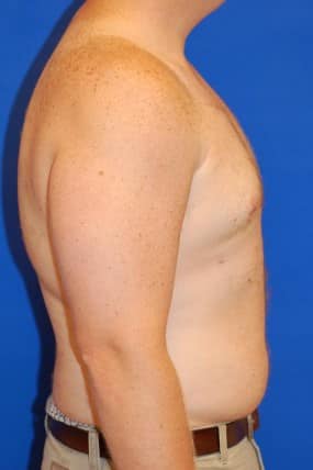 Male Breast Reduction