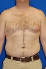 Male Breast Reduction