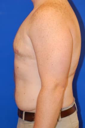 Male Breast Reduction