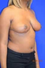 Breast Reduction