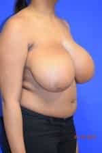 Breast Reduction