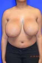 Breast Reduction