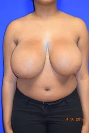 Breast Reduction