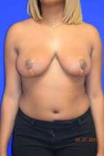 Breast Reduction