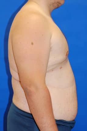 Male Breast Reduction