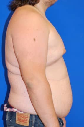 Male Breast Reduction