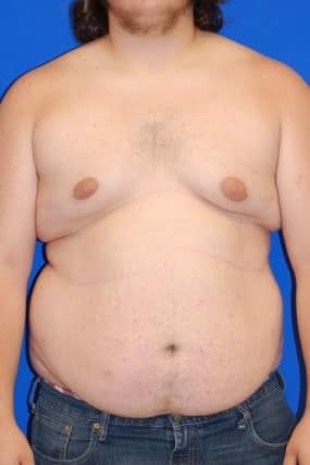 Male Breast Reduction