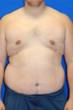 Male Breast Reduction