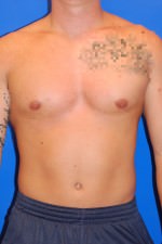 Male Breast Reduction