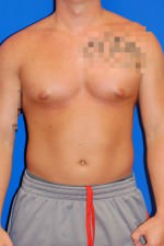 Male Breast Reduction