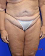 Liposuction