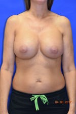 Breast Augmentation