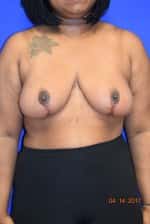 Breast Reduction