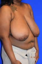Breast Reduction