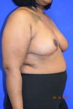 Breast Reduction