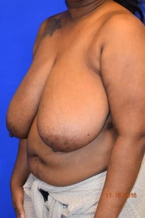 Breast Reduction