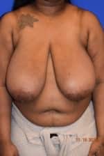 Breast Reduction