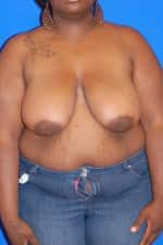Breast Reduction