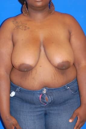 Breast Reduction