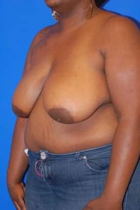 Breast Reduction