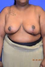 Breast Reduction