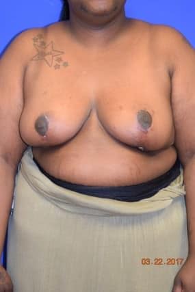 Breast Reduction